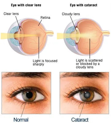 Cataract Surgery | LV Prasad Eye Hospital Consultant (By Senior Eminent Alumni)