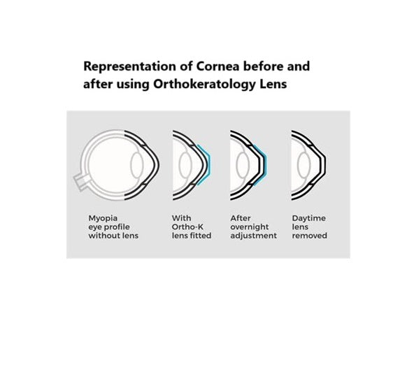 Orthokeratology Lens | By Senior Eminent Optometrist