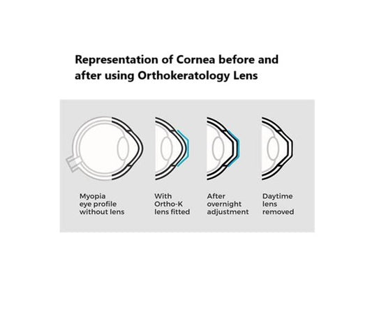 Orthokeratology Lens | By Senior Eminent Optometrist